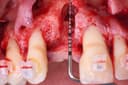 Formation : Greffes de Sinus – Sinus Lift et Techniques Avancées de Reconstruction Osseuse
