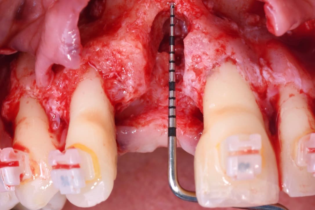Formation : Greffes de Sinus – Sinus Lift et Techniques Avancées de Reconstruction Osseuse