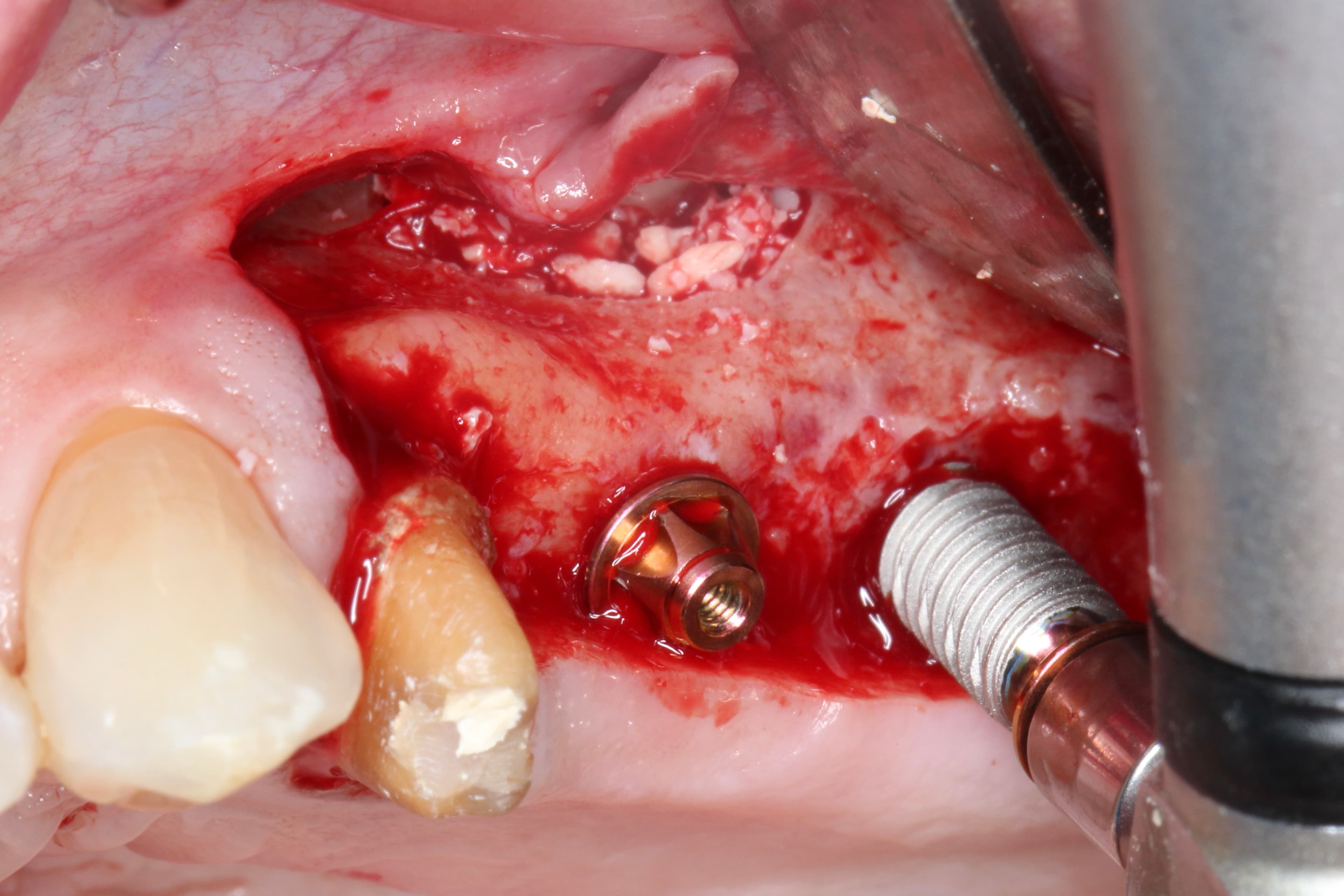 Formation : Extraction-Implantation Immédiate – Maîtriser le Timing et la Précision Chirurgicale